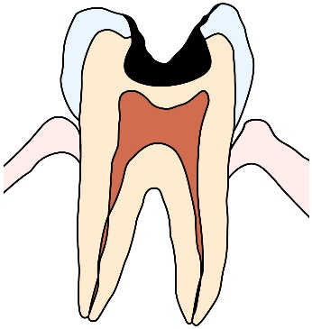 歯の内部まで進行した虫歯